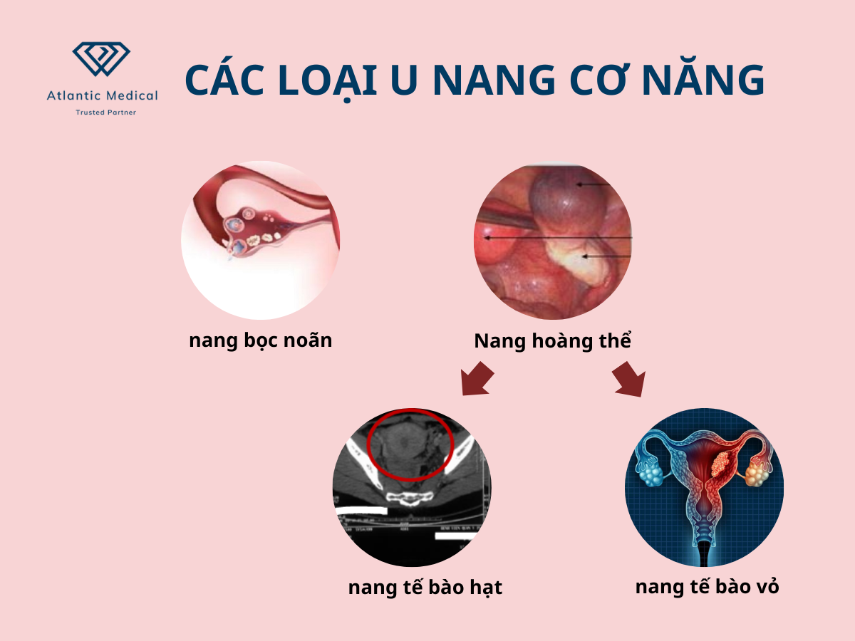 Các loại u nang cơ năng