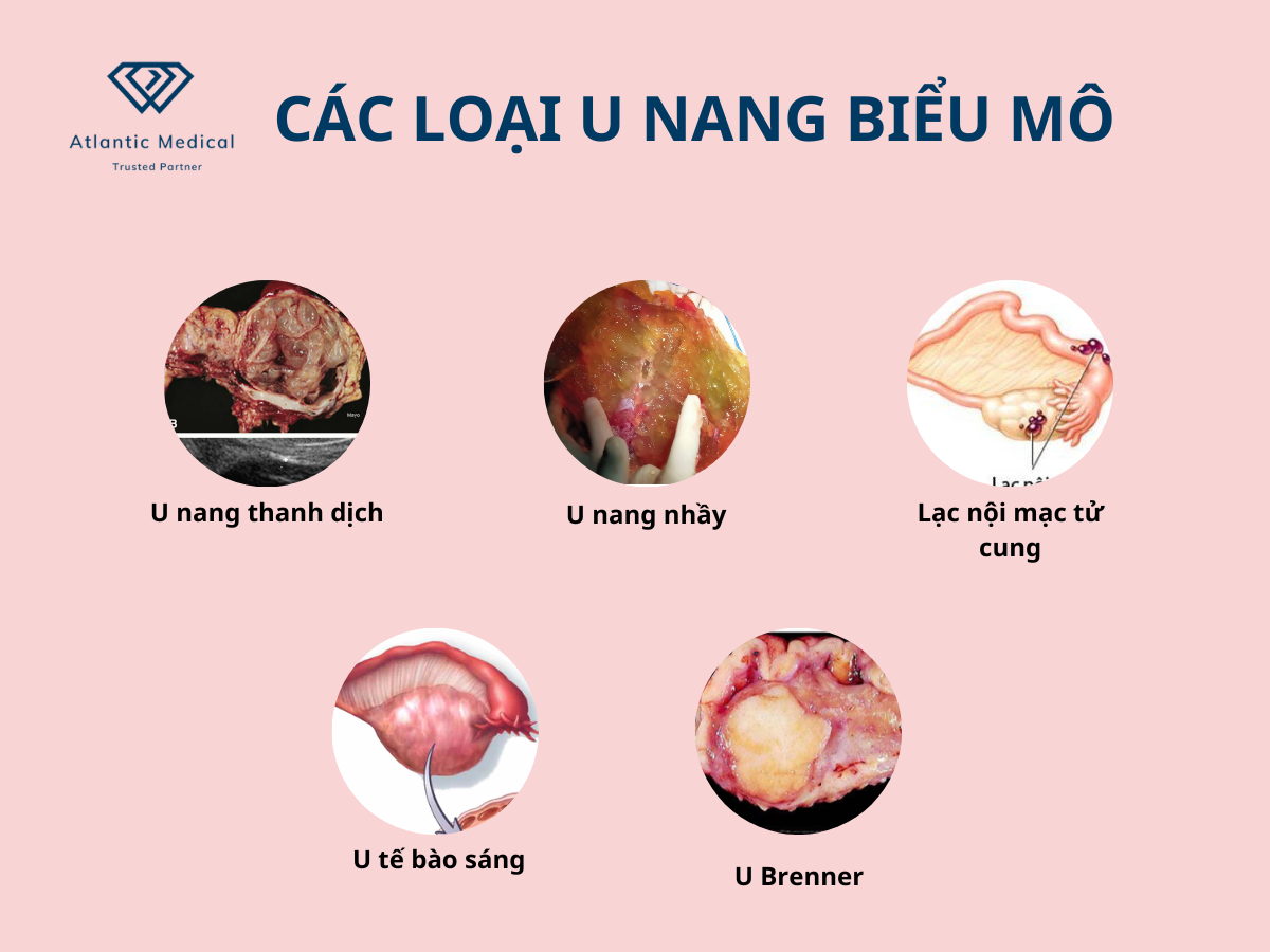 Các loại u nang biểu bì trong buồng trứng 