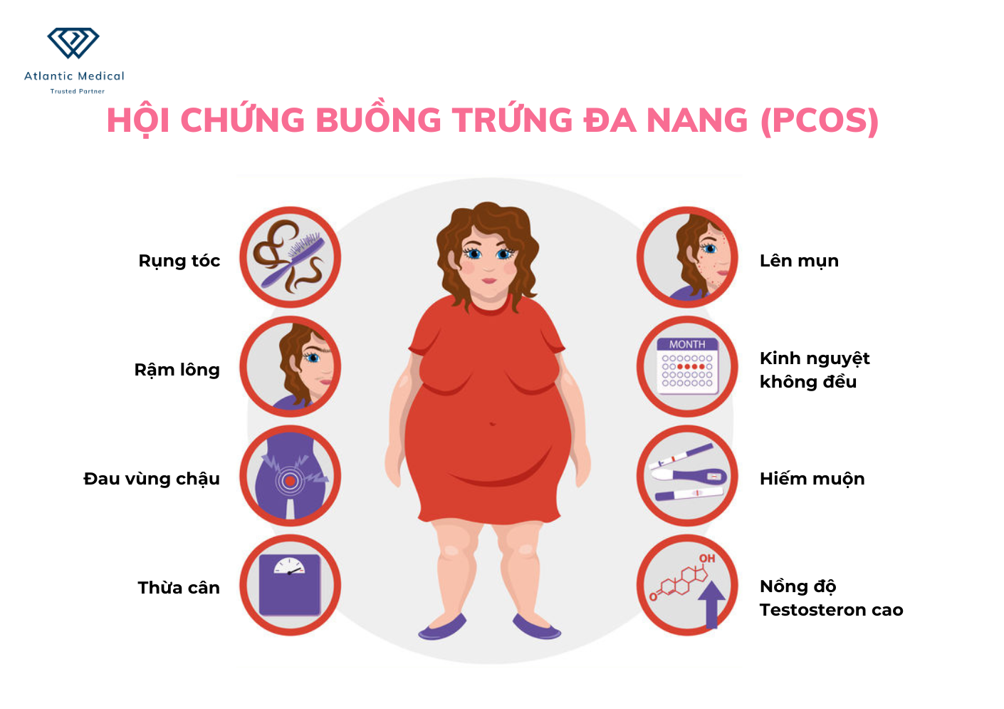 Các dấu hiệu điển hình của hội chứng buồng trứng đa nang.