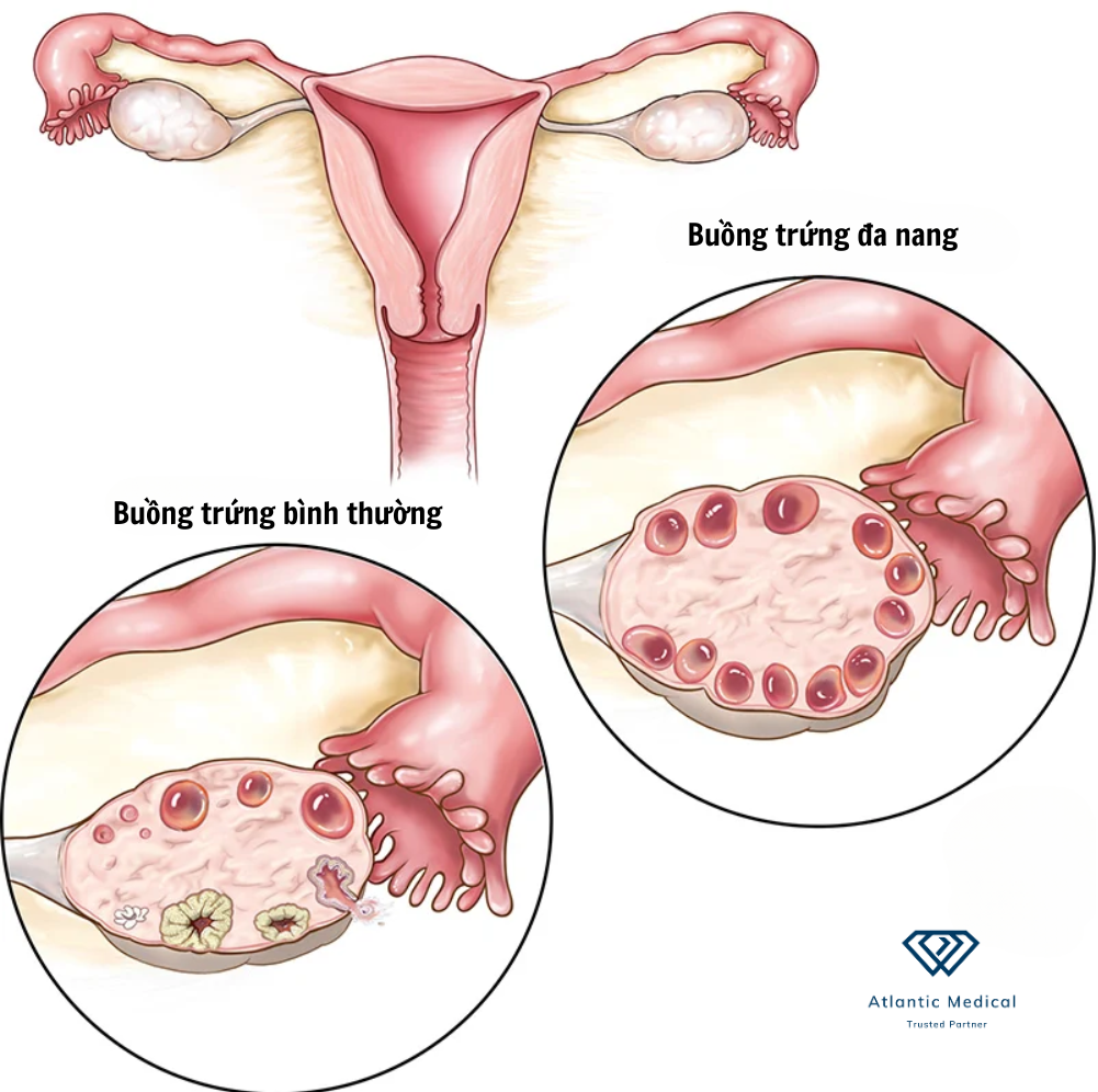 PCOS hình thành các nang nhỏ chứa đầy trứng chưa trưởng thành trên buồng trứng.