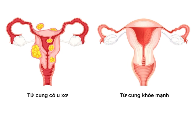 U xơ tử cung hình thành các khối u trong hoặc trên thành tử cung.