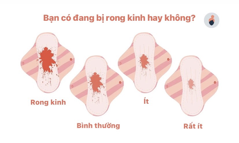 Rong kinh xảy ra khi lượng máu kinh lớn hơn 80ml hoặc số ngày hành kinh kéo dài hơn 7 ngày.