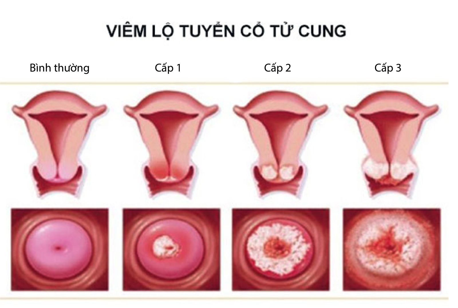 Hình ảnh viêm lộ tuyến tại cổ tử cung