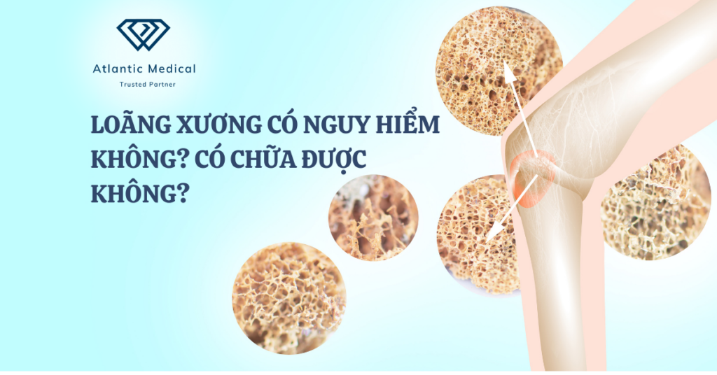 Loãng Xương Có Nguy Hiểm Không? Có Chữa Được Không?