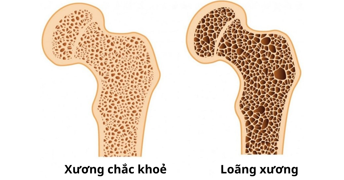 Xương của người loãng xương có cấu trúc giòn hơn, xốp hơn, mật độ khoáng chất ít hơn xương bình thường