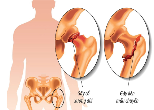 Biến chứng gãy cổ xương đùi khá nguy hiểm, đặc biệt ở người cao tuổi